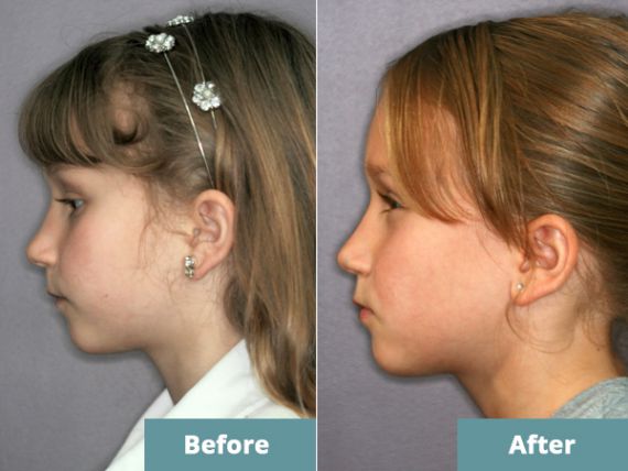 Before/after combined