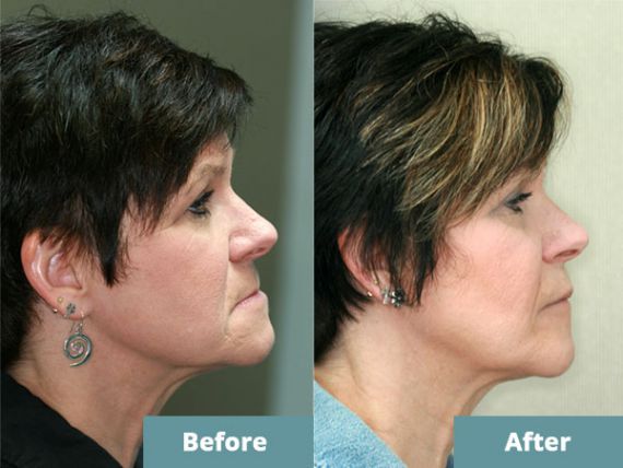 Deb, before and after combined