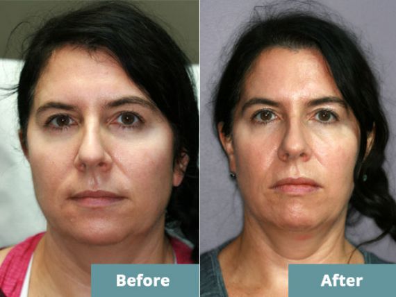 Marine, before and after