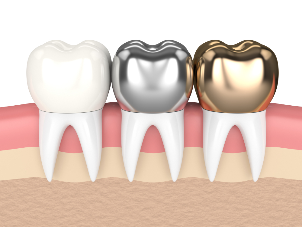 Tooth Crowns