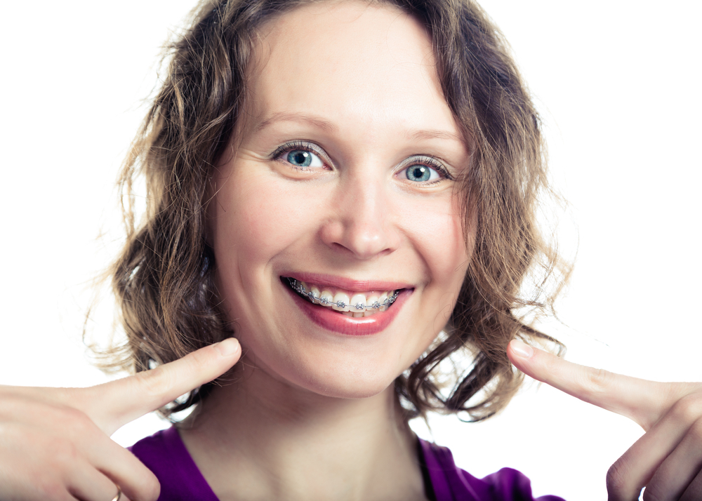 Woman smiling and pointing to her braces