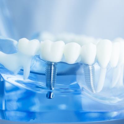dental implants