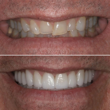 Porcelain Veneers Transformations 1