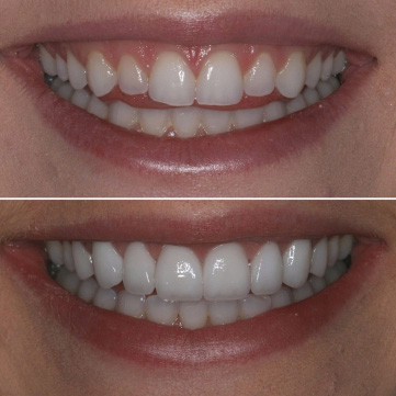 Porcelain Veneers Transformations 3