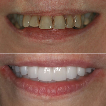 Cosmetic Dentistry Treatment - Transformations 1