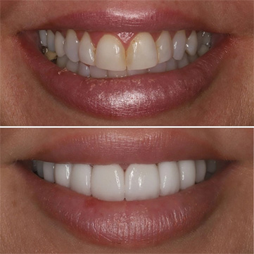 Porcelain Veneers Transformations 2