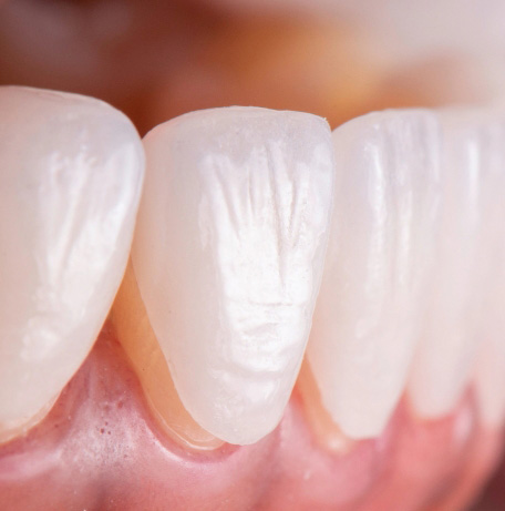 Porcelain Veneers Procedure
