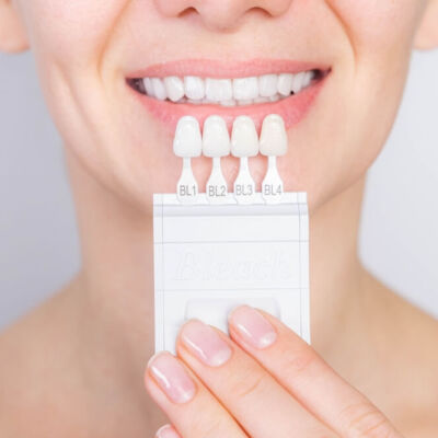 Porcelain Veneers